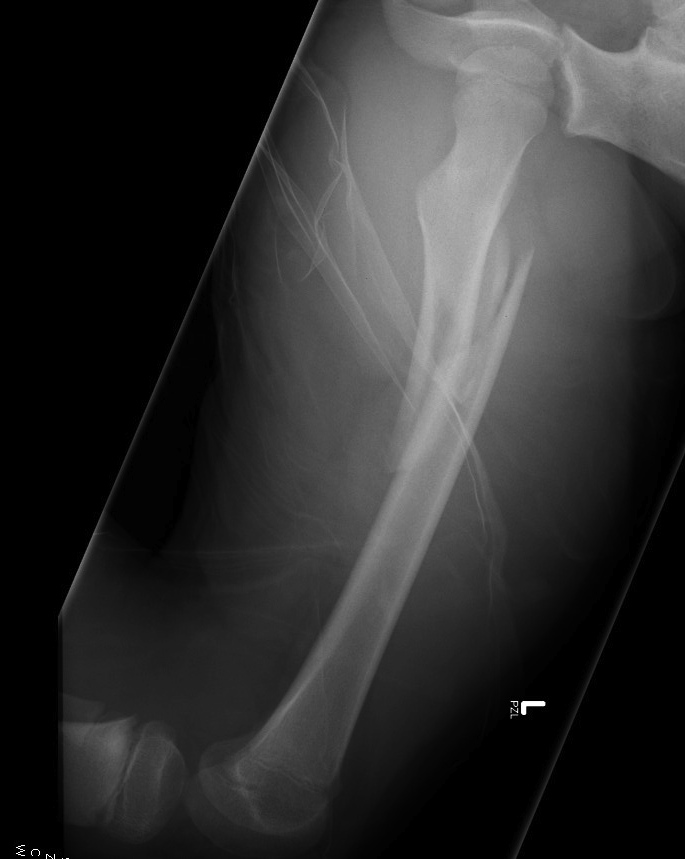 Pediatric Femoral Fracture Spiral